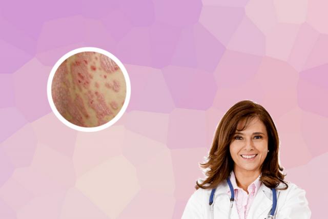 湿疹是什么原因引起的 怎么根治