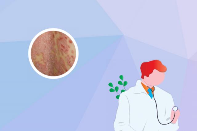 慢性湿疹怎么治疗能除根
