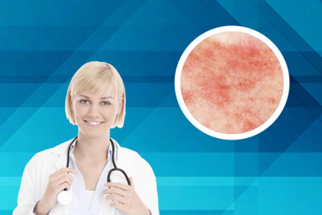 霉菌性皮肤感染用什么药