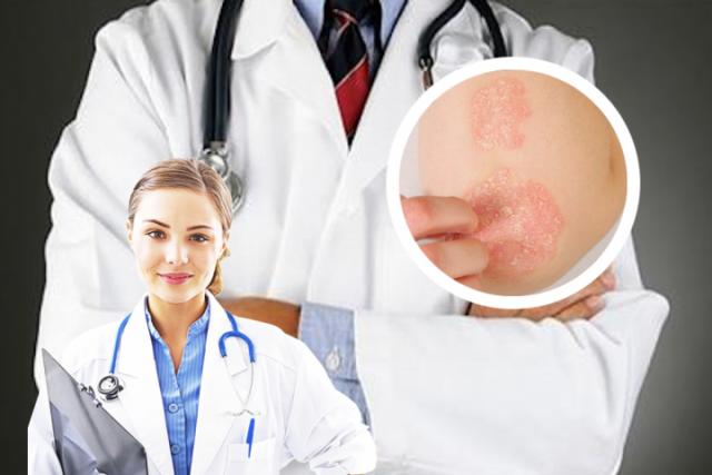 皮肤癣菌病 治疗方法