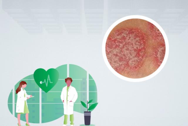 湿疹的症状表现及治疗方法