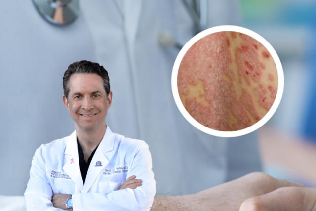 真菌感染引起的皮肤癣能自愈吗