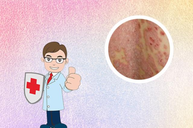 牛皮肤癣早期症状的长痘么