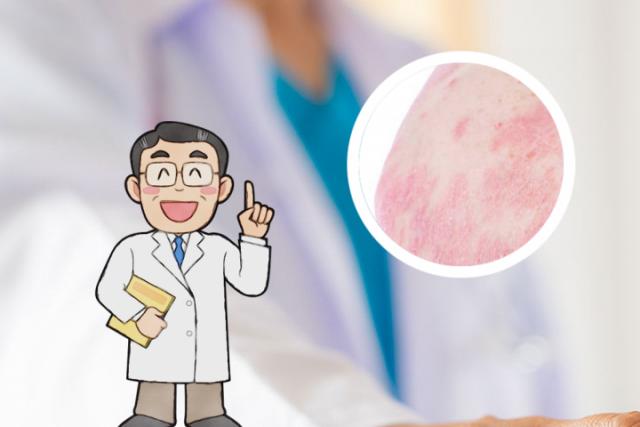 湿疹和皮癣应该用什么药