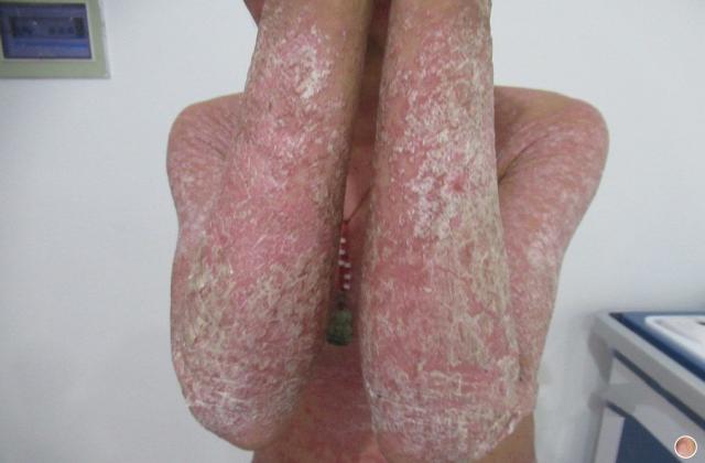 手指上的红斑点型银屑病 手指上的红斑点性银屑病