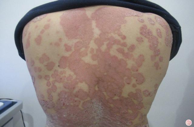 背部红点银屑病 背部红点是银屑病吗