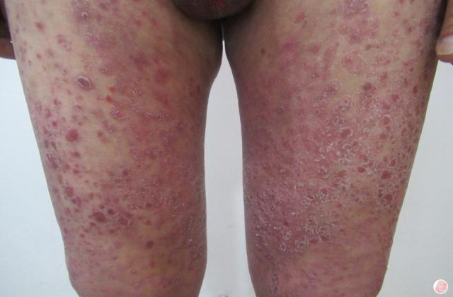 连续性肢端皮炎是银屑病吗 连续性肢端皮炎银屑病